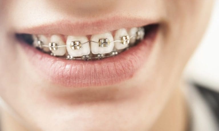 How Do You Know if Braces Are Right for Your Kids?