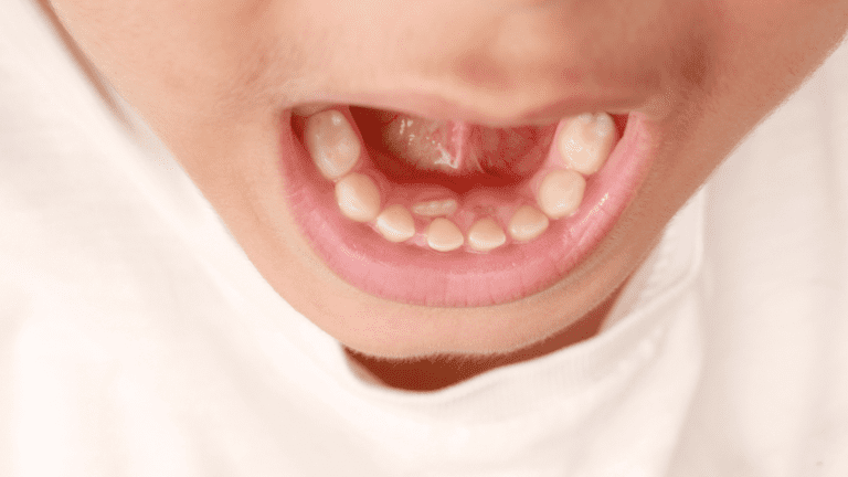 Navigating Through Childhood Dental Problems and How to Avoid Them